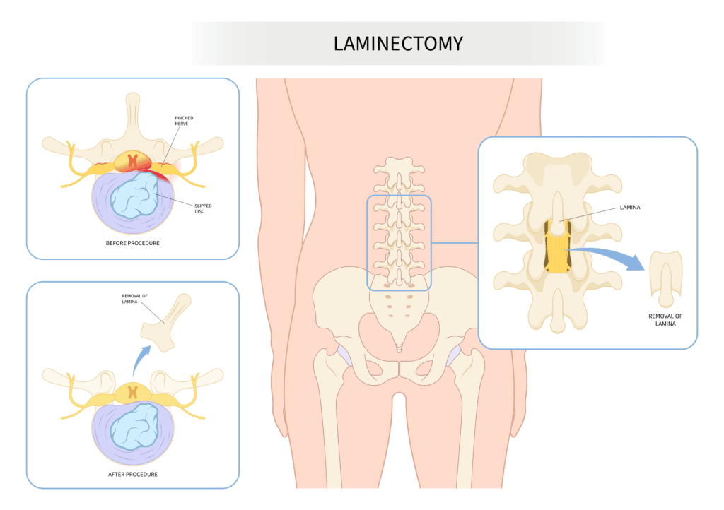 Espondilosis lumbar tratamiento