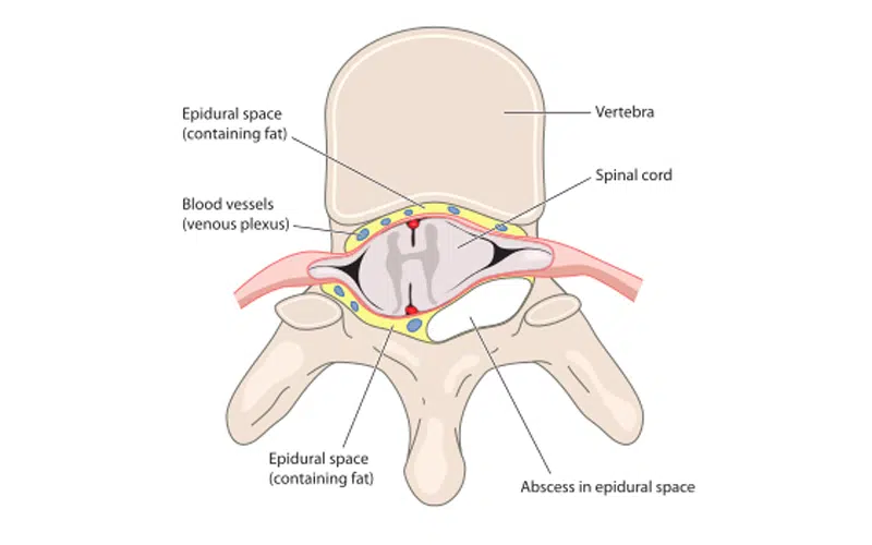 Epidural Abscess