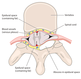 Cross sectional view of the spine showing an epidural abscess