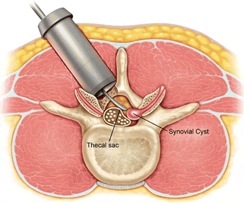 Synovial Cyst