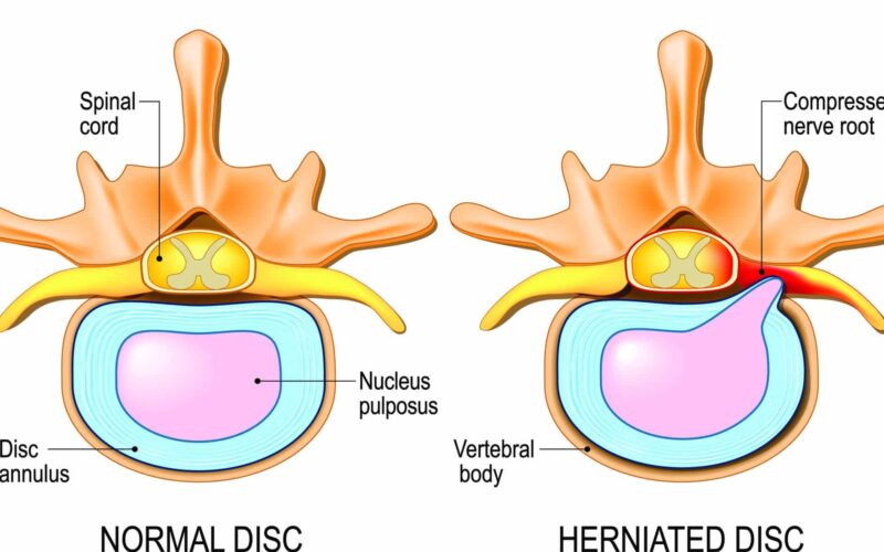 Normal Spinal Cord vs Compressed Nerve Root