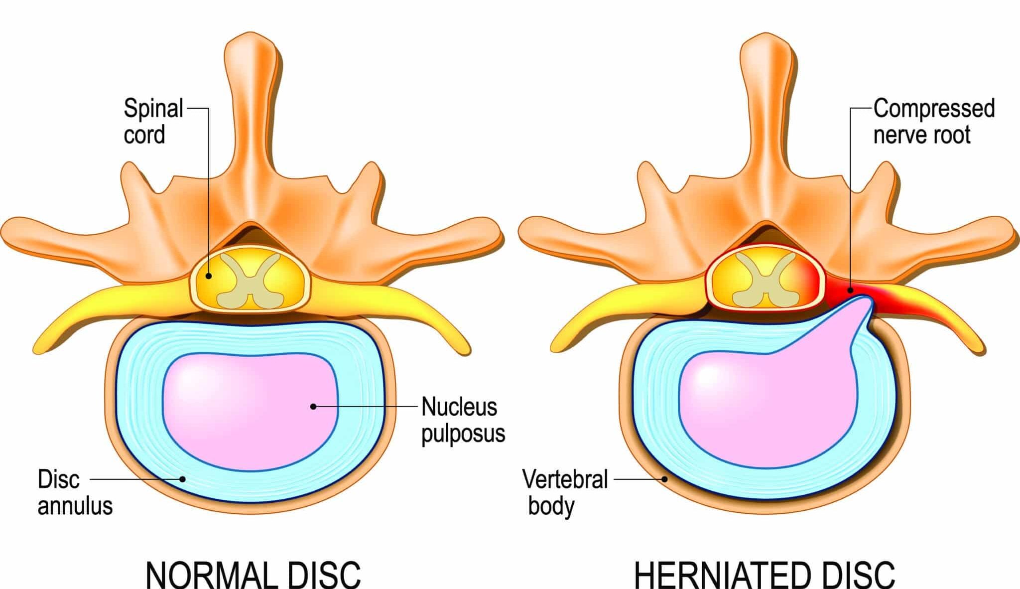 Normal Spinal Cord vs Compressed Nerve Root