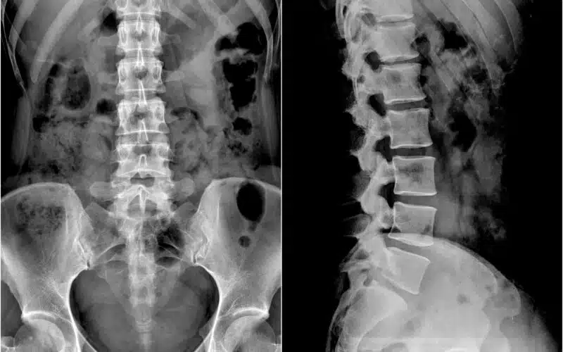 Spine and Pelvis XRay