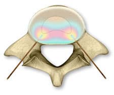 Biacuplasty Isotherm