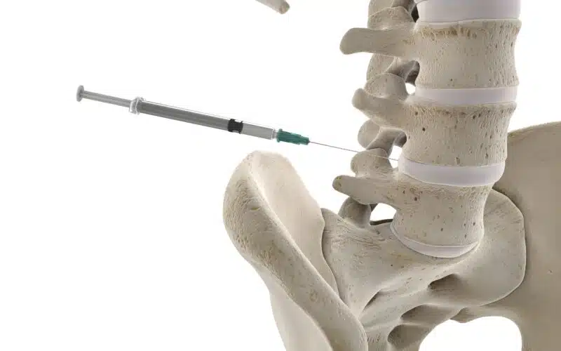 3d rendered medically accurate illustration of a lumbar spine injection