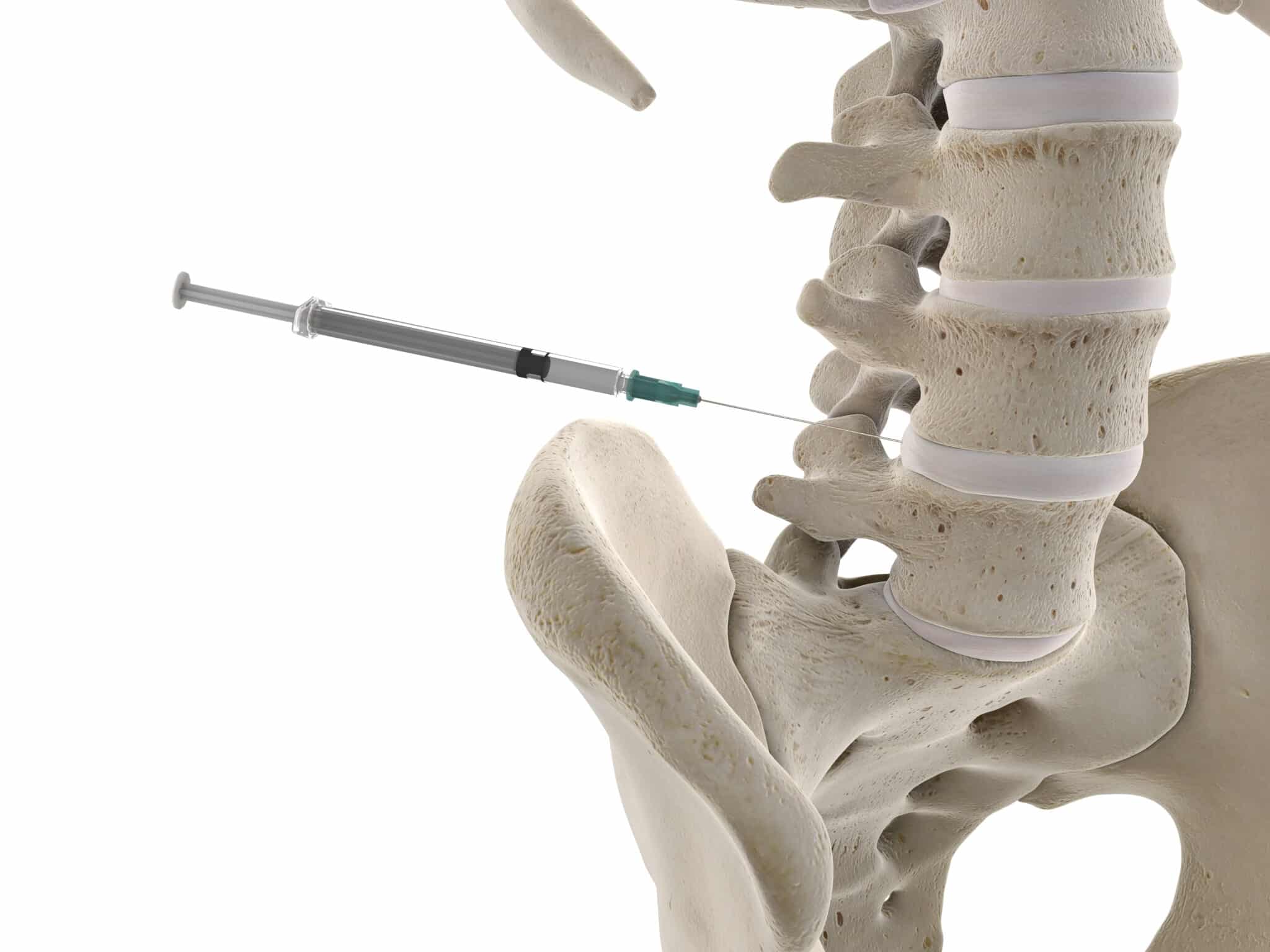 3d rendered medically accurate illustration of a lumbar spine injection