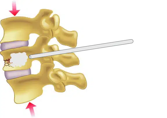 Vertebroplasty diagram