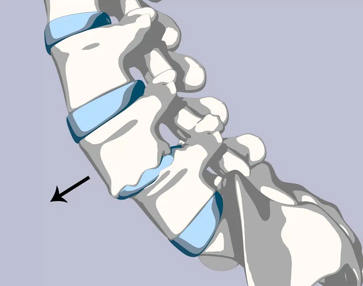 Anterolisthesis, Spondylolisthesis