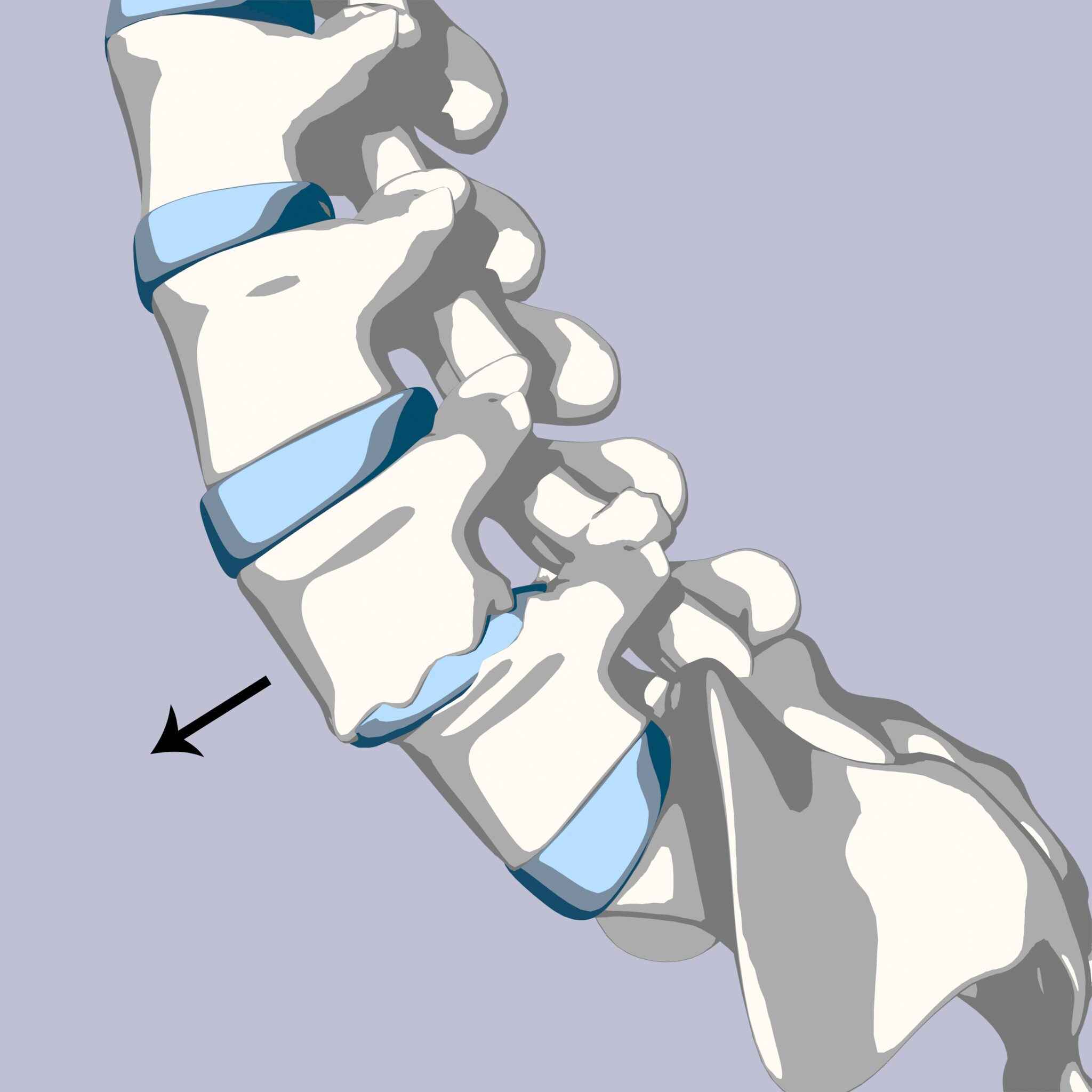 Anterolisthesis