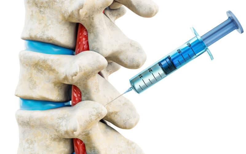 Facet Joint Injection Therapy for Back Pain