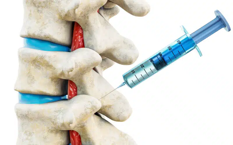 Facet Joint Injection Therapy for Back Pain