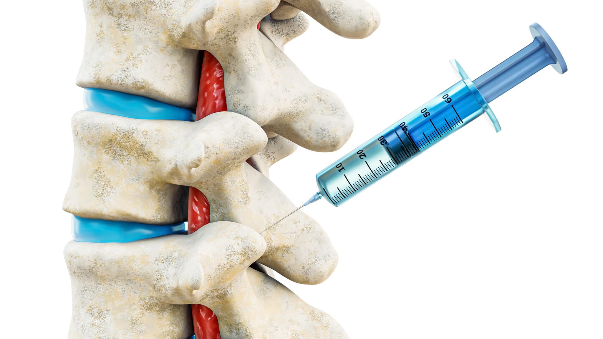 Facet Joint Injection Therapy for Back Pain