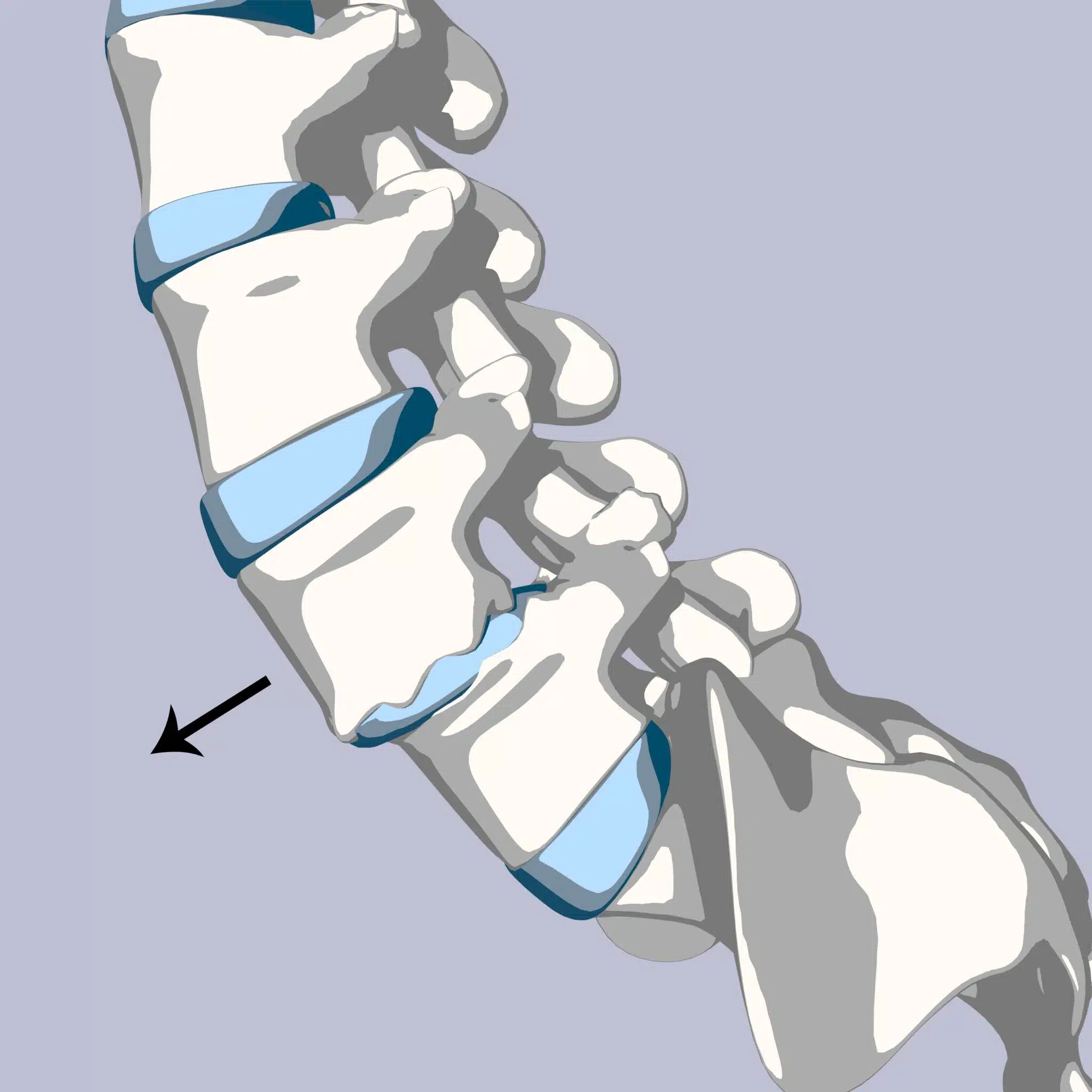 Anterolisthesis, spondylolisthesis