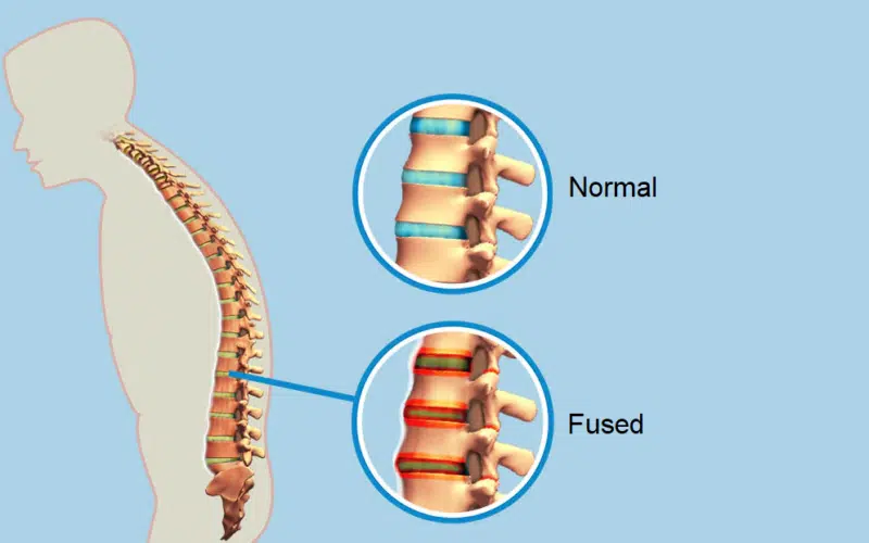 Bechterew's Disease aka Ankylosing Spondylitis