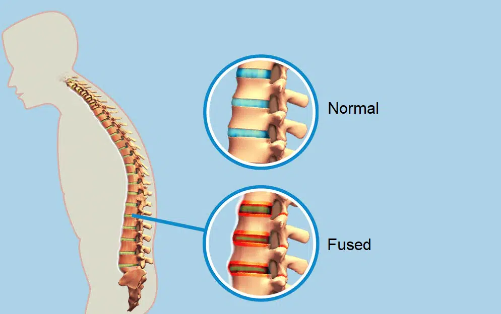 Bechterew's Disease aka Ankylosing Spondylitis