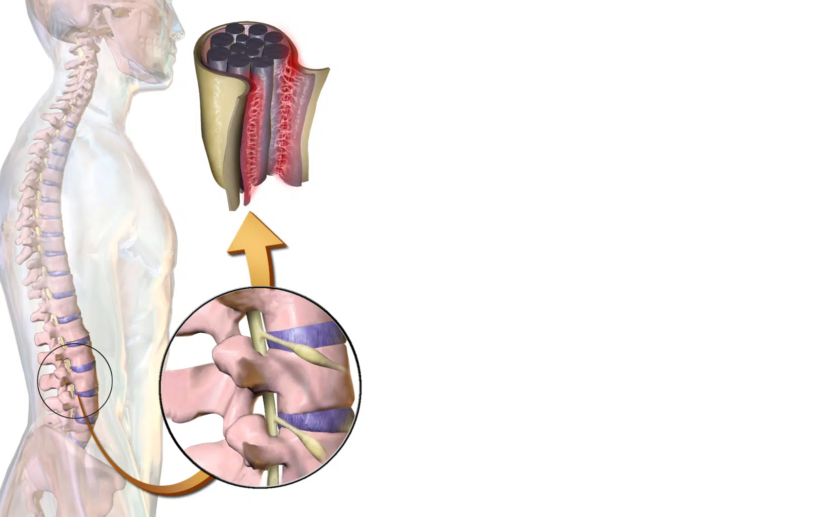 What is Arachnoiditis?