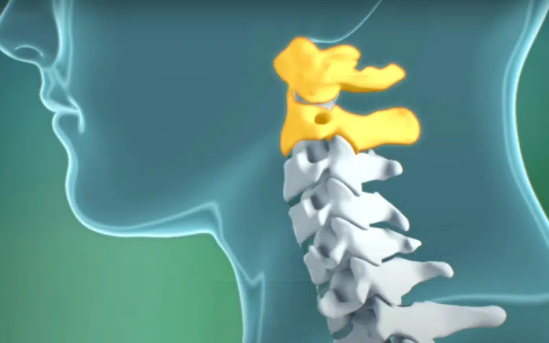 Atlantoaxial instability