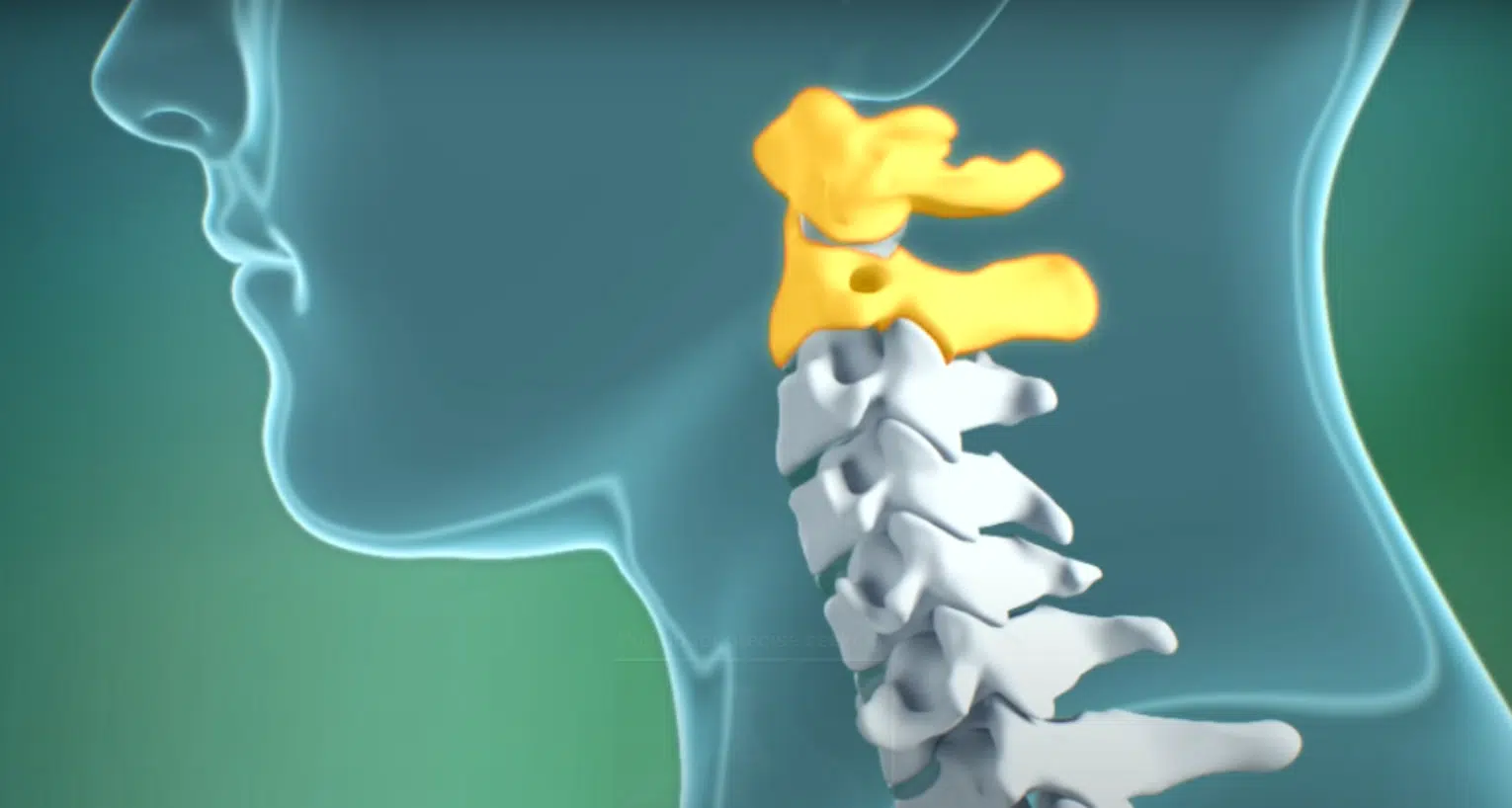 Atlantoaxial instability