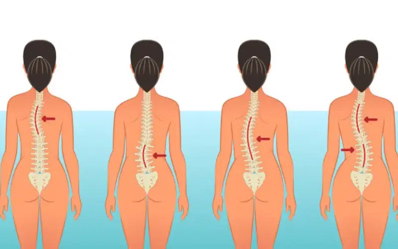 Juvenile Idiopathic Scoliosis