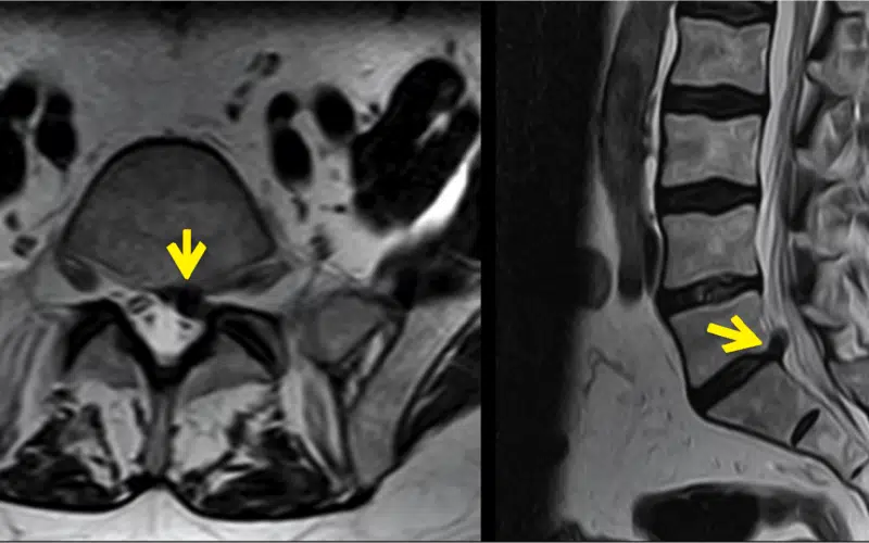 Thecal Sac Effacement, Thecal Sac Compression