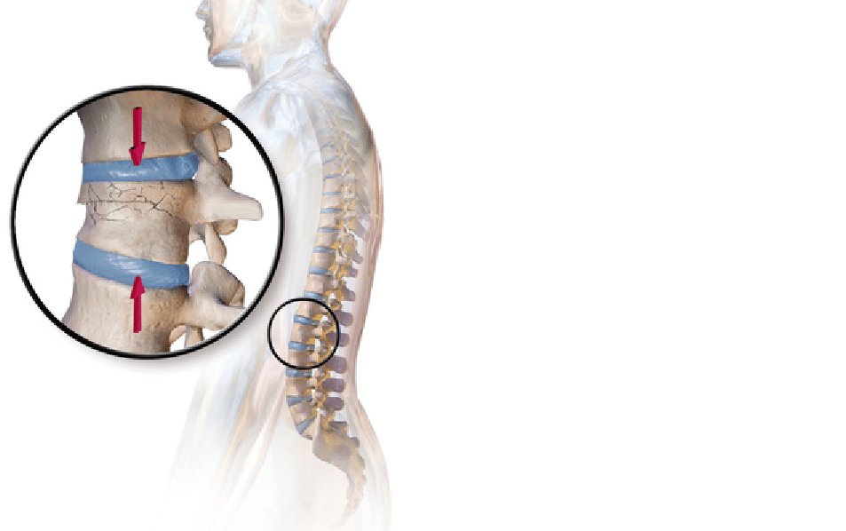 Vertebral Compression Fracture: Definition - Spine Info