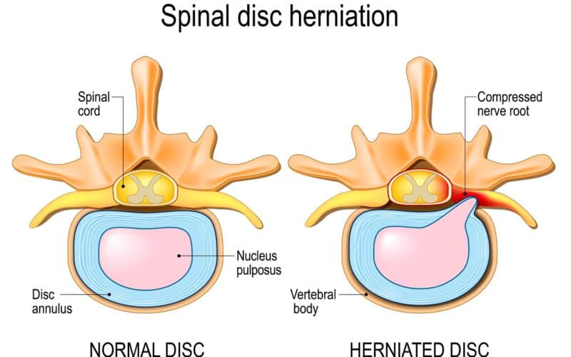Disc Herniation, Herniated Disc