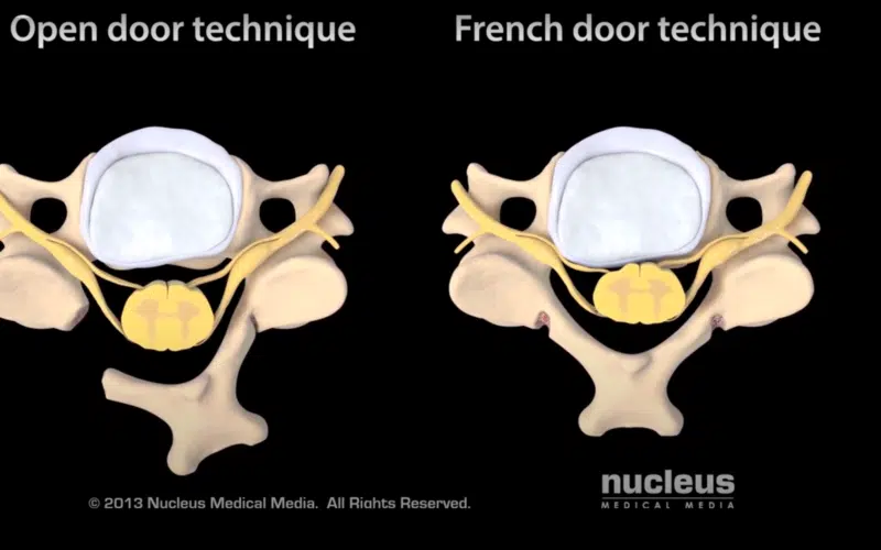 Cervical Laminoplasty Neck Spine Surgery