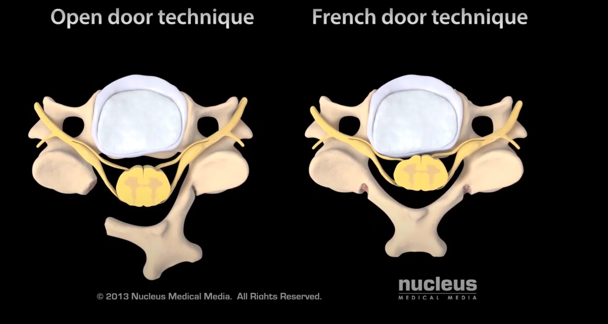 Cervical Laminoplasty Neck Spine Surgery