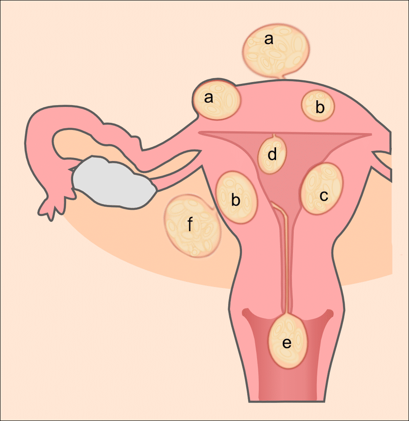 Schematic drawing of various types of uterine fibroids: a=subserosal fibroids, b=intramural fibroids, c=submucosal fibroid, d=pedunculated submucosal fibroid, e=cervical fibroid, f=fibroid of the broad ligament. Courtesy of Wikipedia.