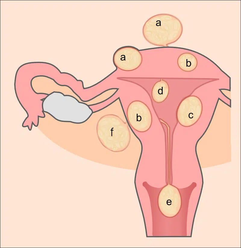 Schematic drawing of various types of uterine fibroids: a=subserosal fibroids, b=intramural fibroids, c=submucosal fibroid, d=pedunculated submucosal fibroid, e=cervical fibroid, f=fibroid of the broad ligament. Courtesy of Wikipedia.