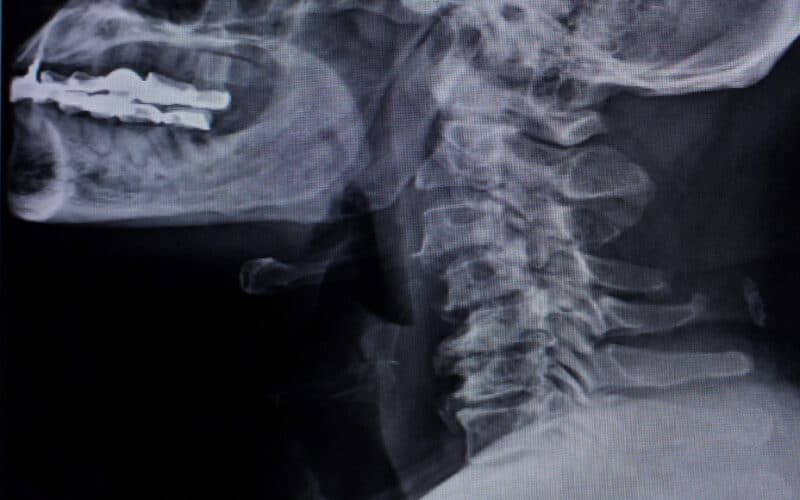 Retrolisthesis