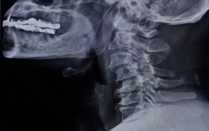 Retrolisthesis