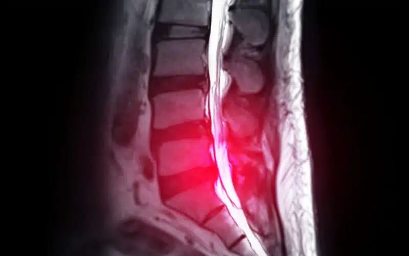 MRI spine