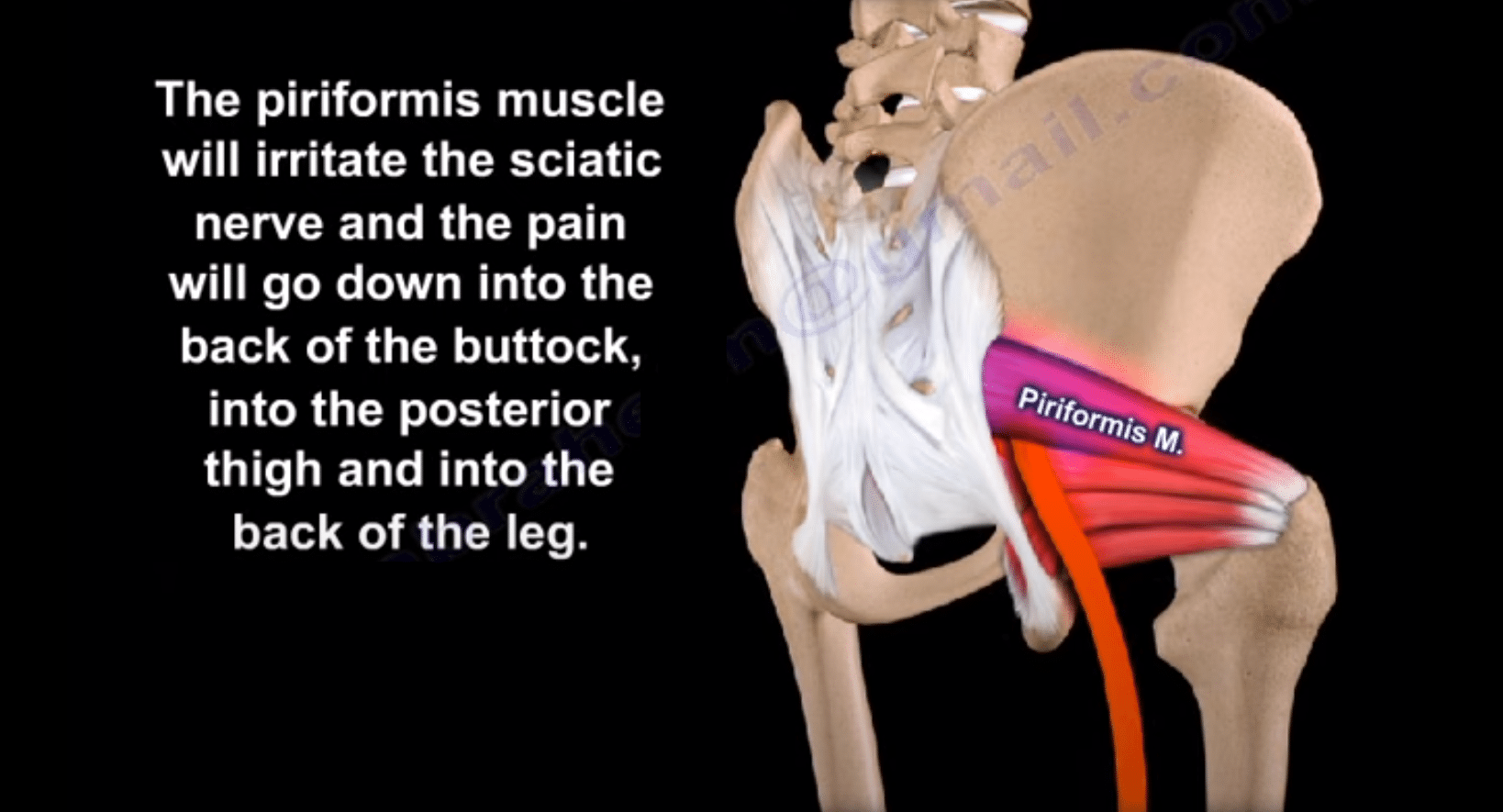 Piriformis Syndrome: Definition - Spine Info