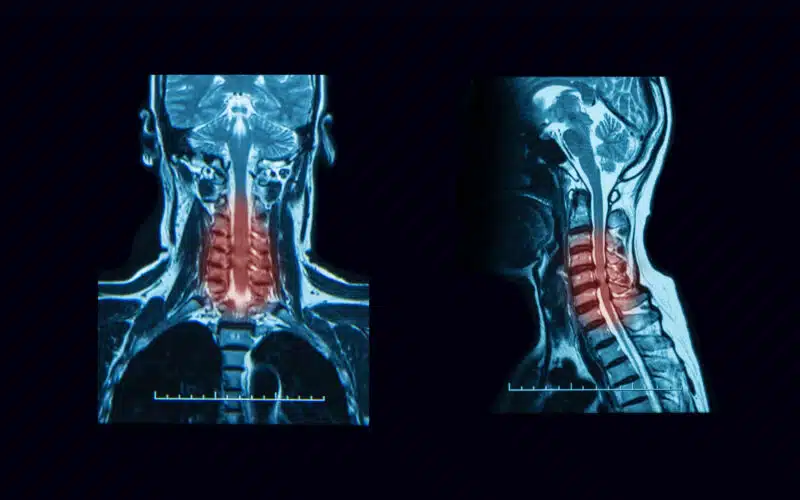 Myelopathy