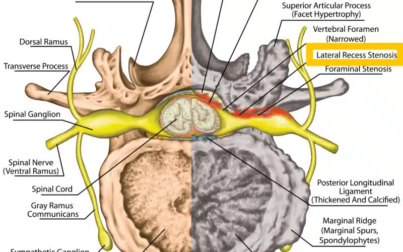 lateral recess stenosis