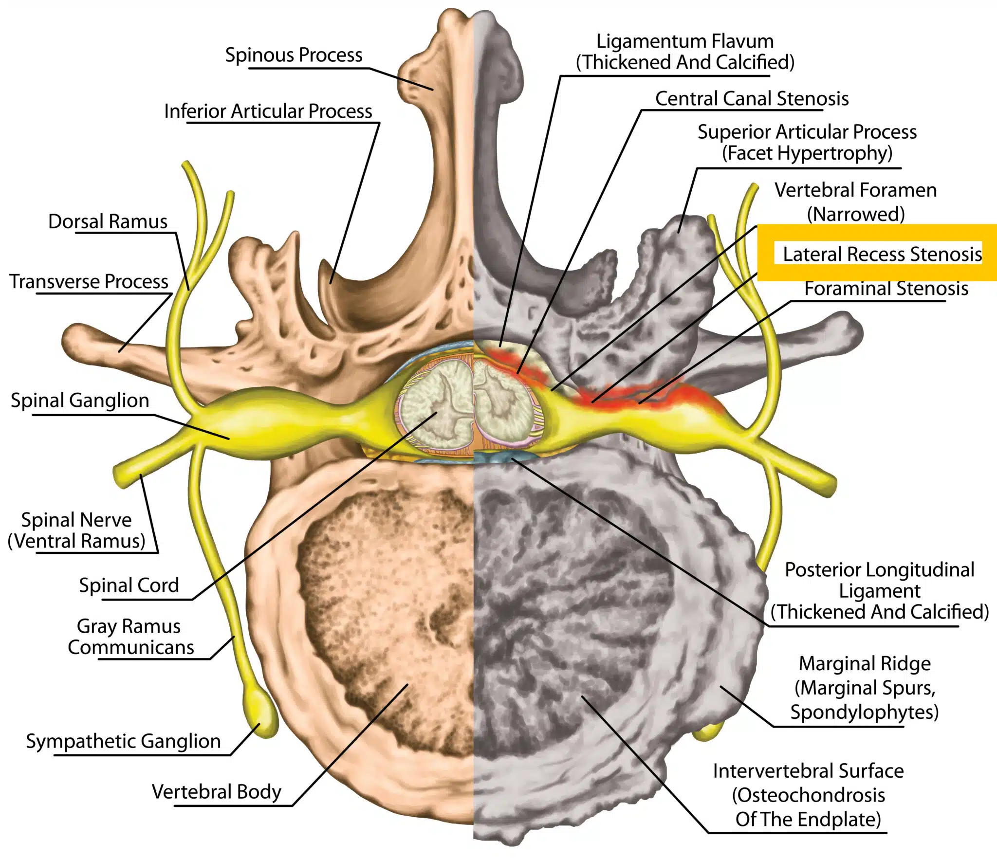 lateral recess stenosis