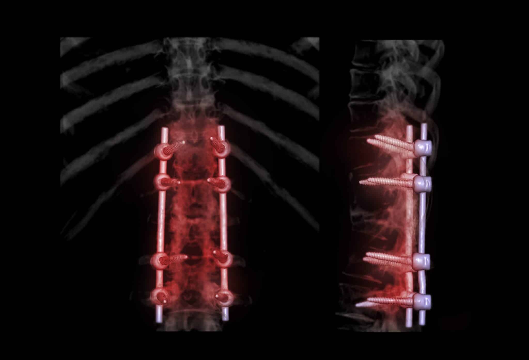 Pedicle screw fusion