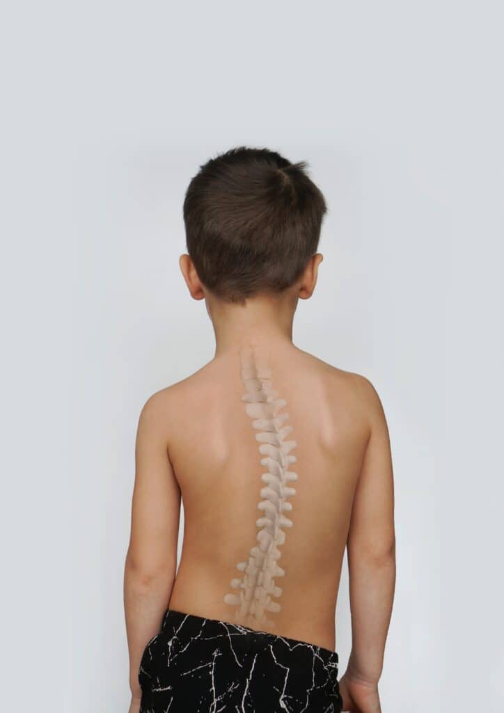 Recognizing Early Signs of Scoliosis in Children: A Guide for Parents ...