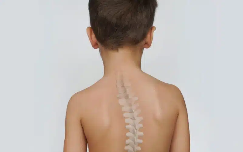 Scoliosis