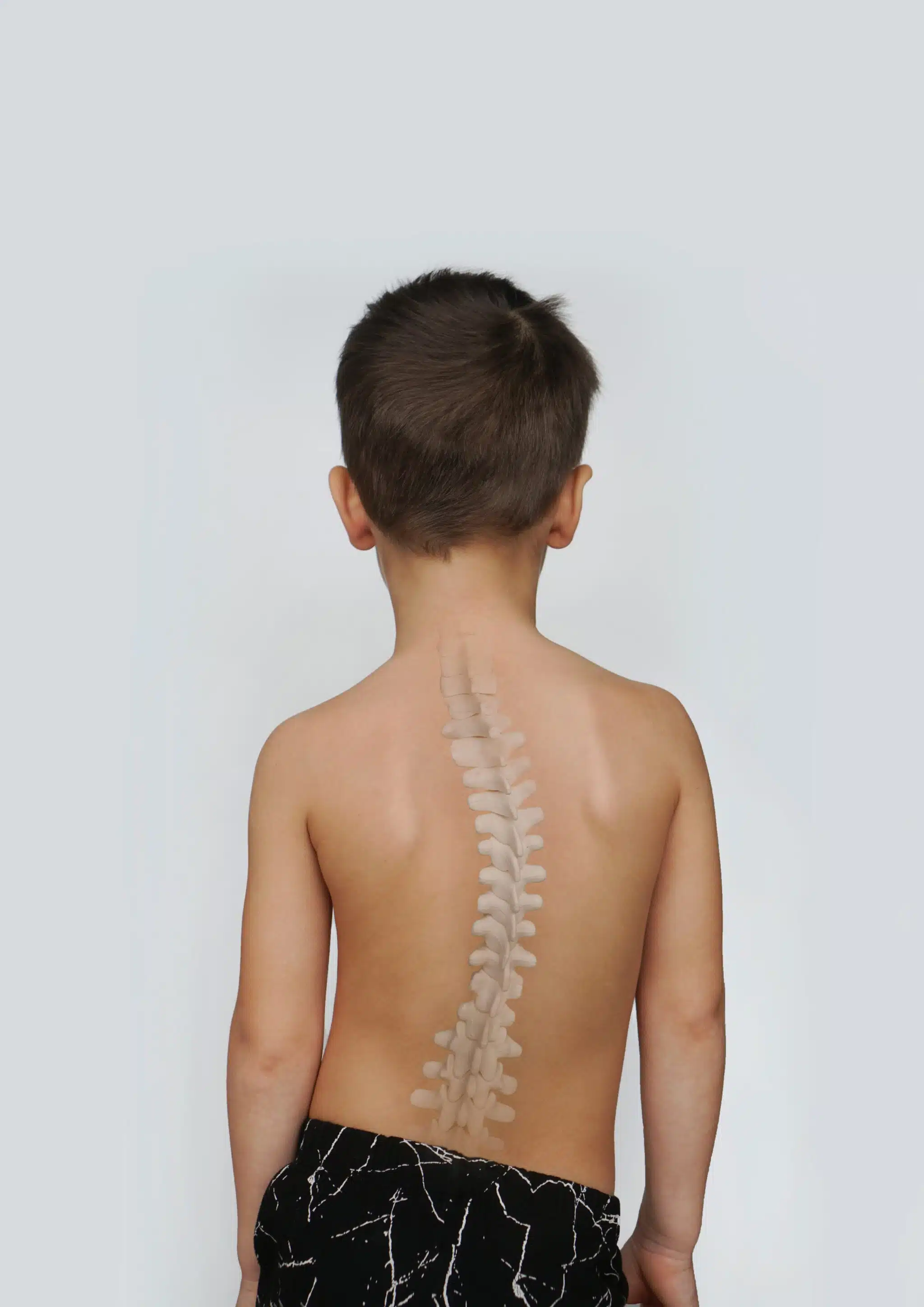 Scoliosis